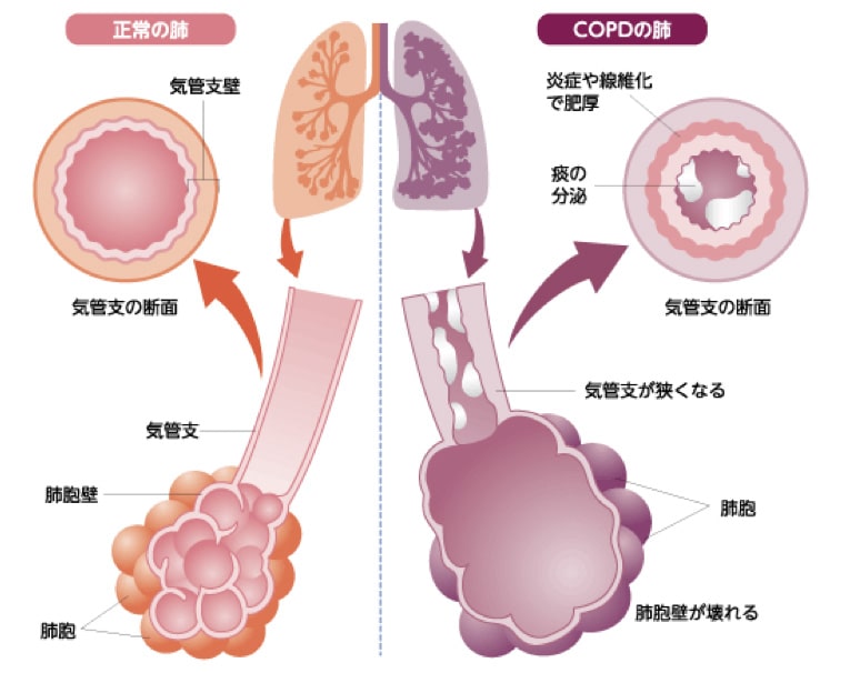 慢性閉塞性肺疾患(COPD)のイメージ写真