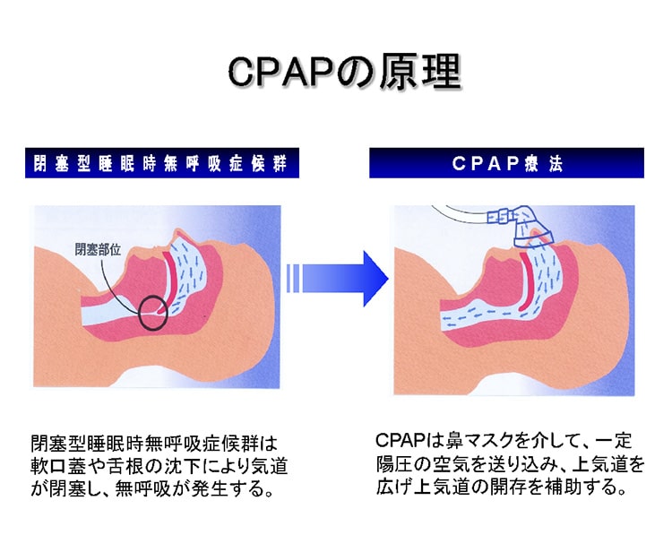 CPAP療法